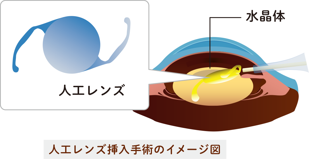 みわ眼科で行う白内障の手術