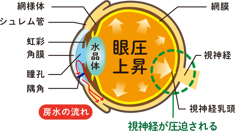 緑内障とは？