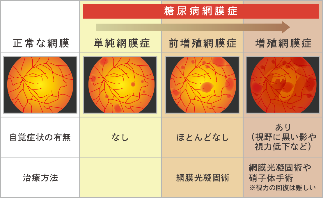 糖尿病網膜症の進み方