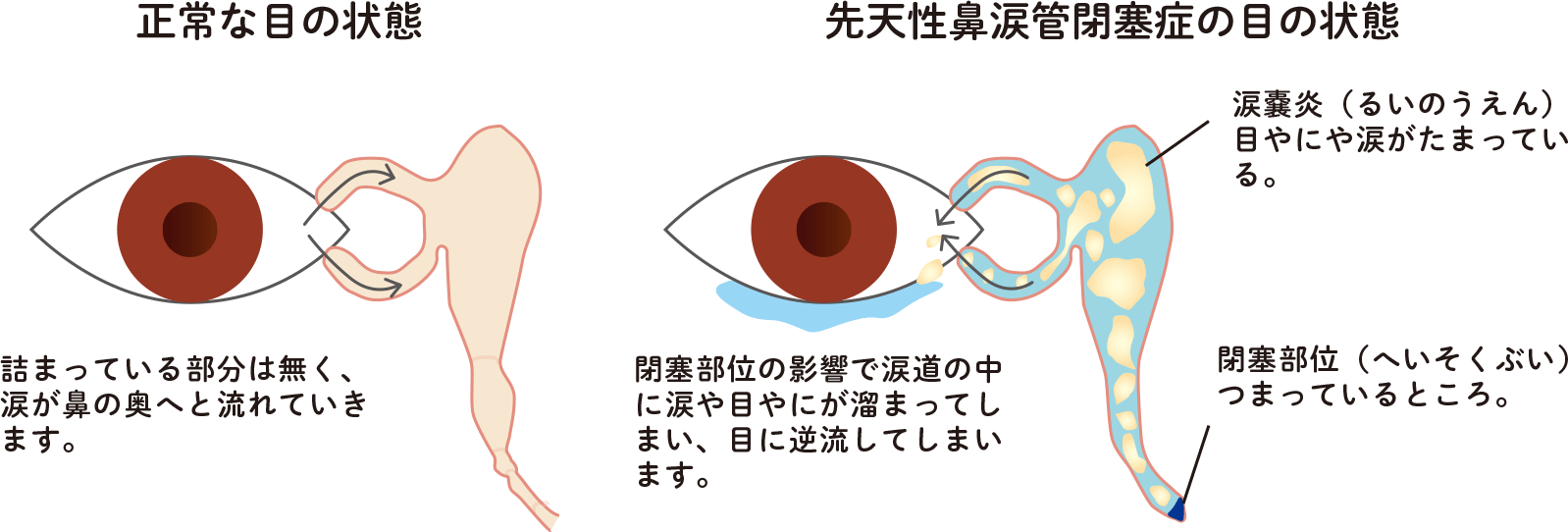 先天性鼻涙管閉塞症