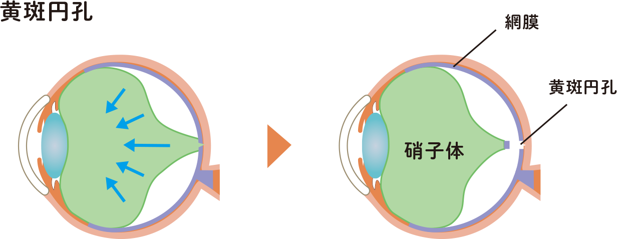 黄斑円孔