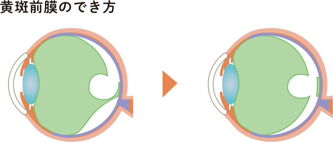 黄斑上膜