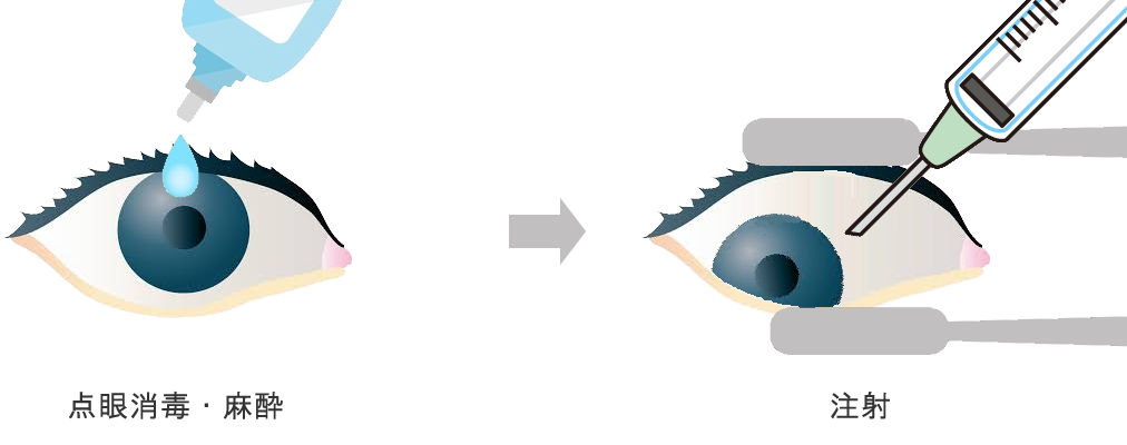 加齢黄斑変性の治療