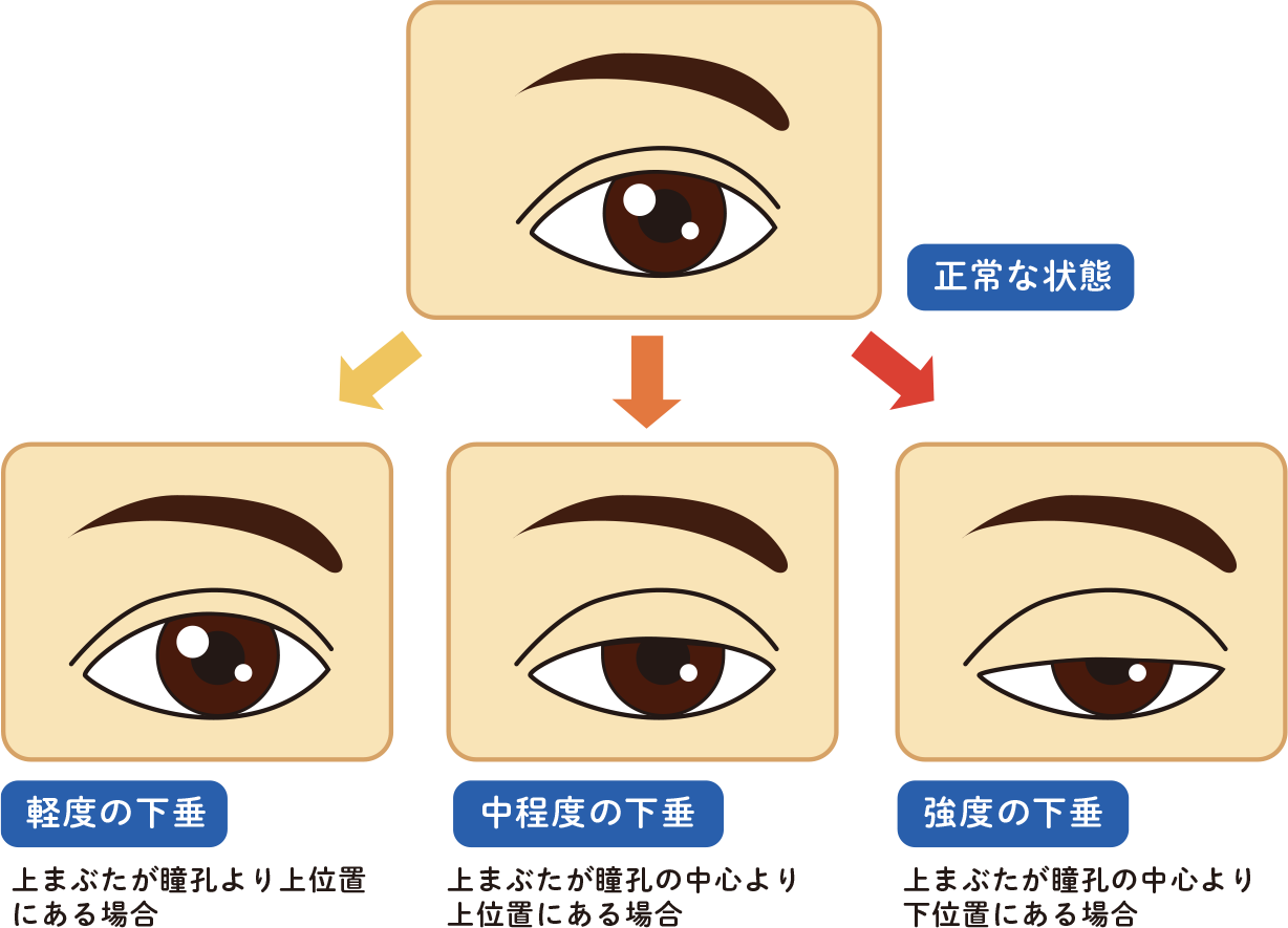 岐阜市で眼瞼下垂の治療ならみわ眼科へ